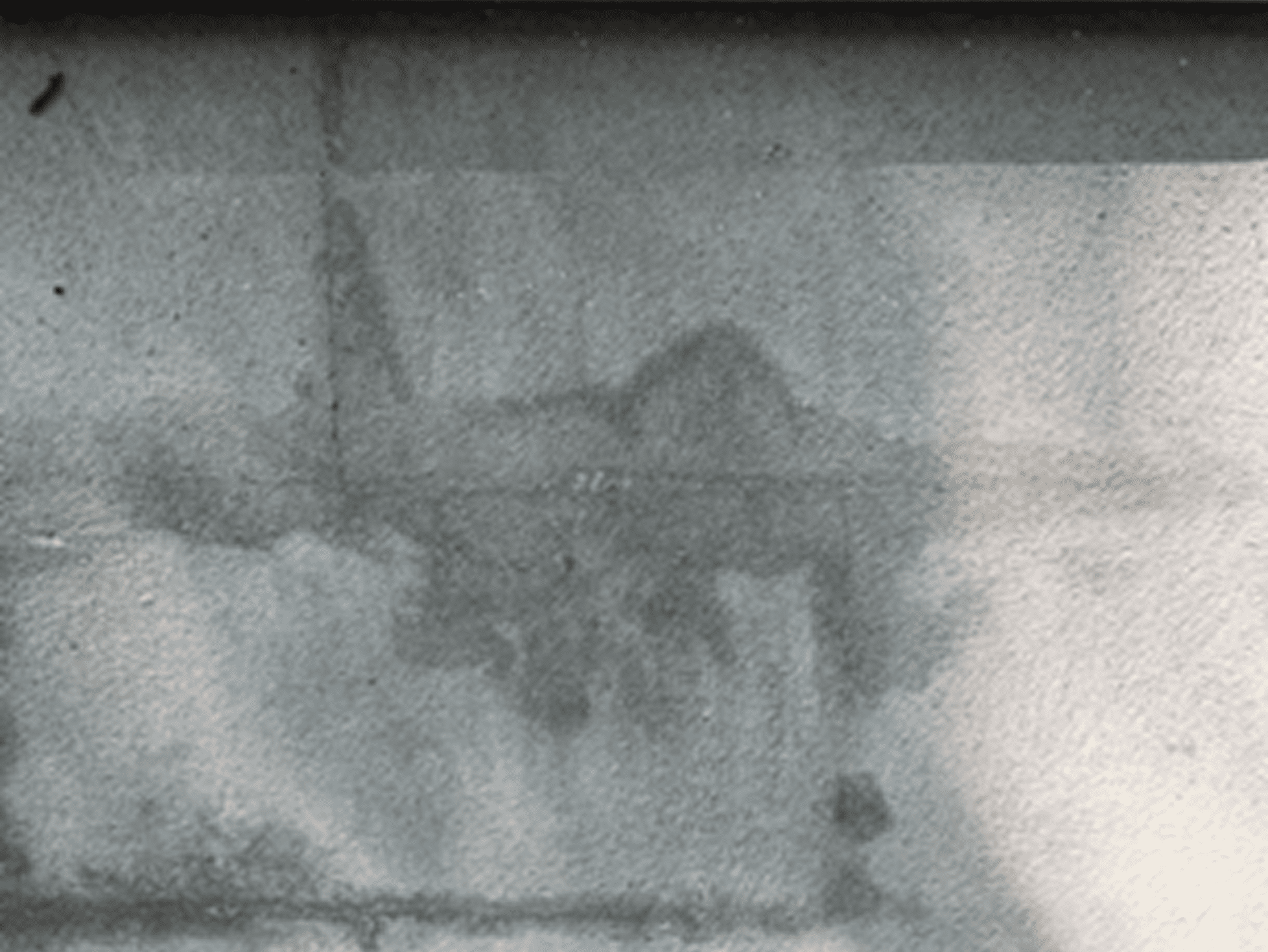 X-ray image showing spinal and pelvic bones.