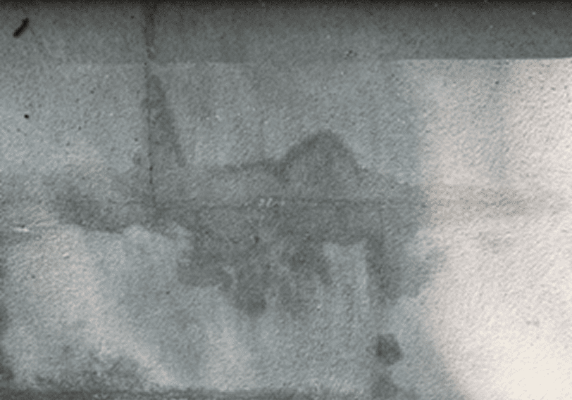 X-ray image showing spinal and pelvic bones.